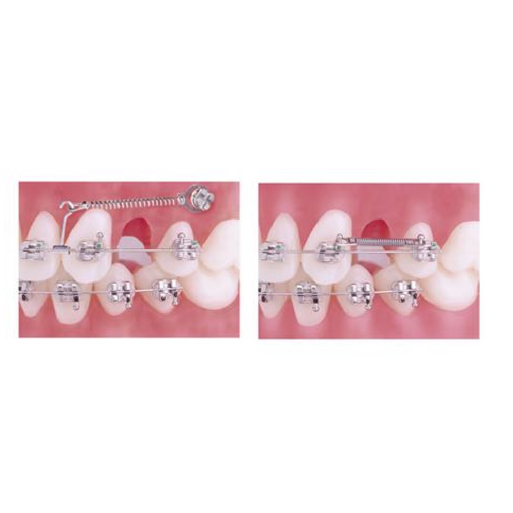 RESSORT FERME NITITRUFLEX AILETTE HVY 9MM ORTHO