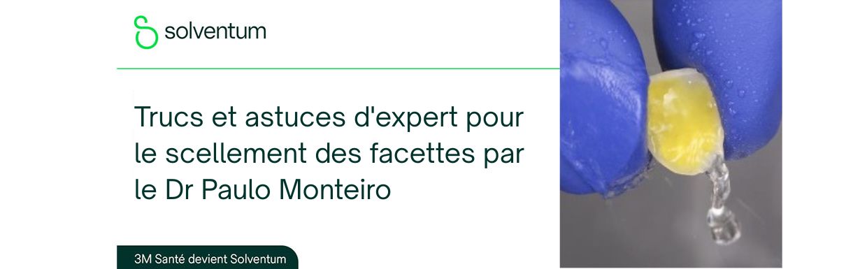 Trucs et astuces d'expert pour le scellement des facettes