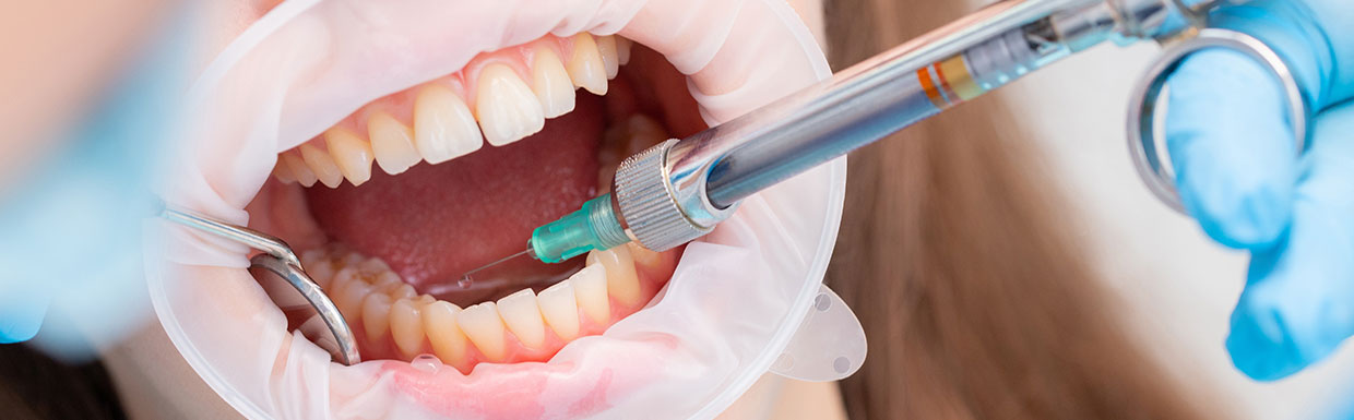 Les différents types d'anesthésies en dentisterie