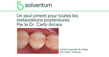 Cas clinique : Un seul ciment pour toutes les restaurations postérieures.