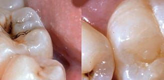 Cas clinique - Composite Bulk Fill (Solventum)