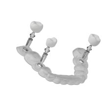 Guide chirurgical implantaire : précision et sécurité en implantologie
