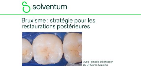Bruxisme et restaurations postérieures : choisir les solutions adaptées pour une santé bucco-dentaire durable