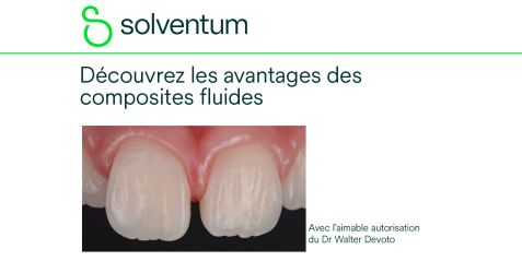 Les composites fluides : comment les intégrer à votre protocole clinique ?