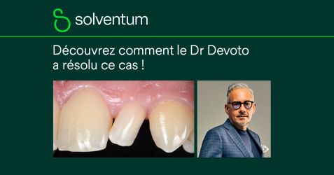 Restauration simplifiée d’une incisive latérale présentant une anomalie de forme et de position