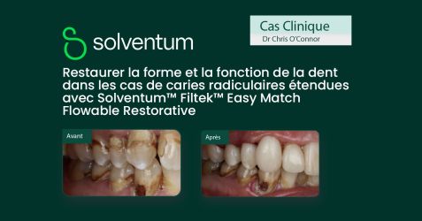 Restaurer la forme et la fonction de la dent dans les cas de caries radiculaires étendues avec Solventum™ Filtek™ Easy Match Flowable Restorative