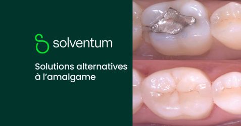 Solutions alternatives à l’amalgame