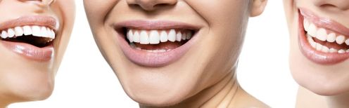 Le blanchiment dentaire : ce qu'il faut savoir