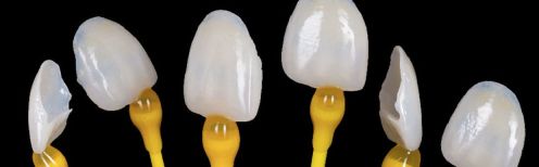 Tout savoir sur les facettes dentaires