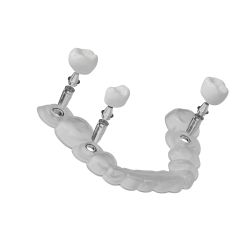 Guide chirurgical implantaire : pr&eacute;cision et s&eacute;curit&eacute; en implantologie