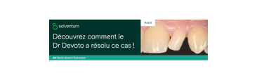 Restauration simplifiée d’une incisive latérale présentant une anomalie de forme et de position