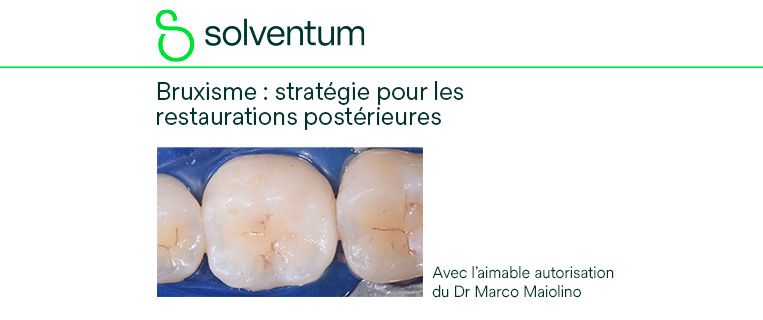 Bruxisme et restaurations postérieures : choisir les solutions adaptées pour une santé bucco-dentaire durable