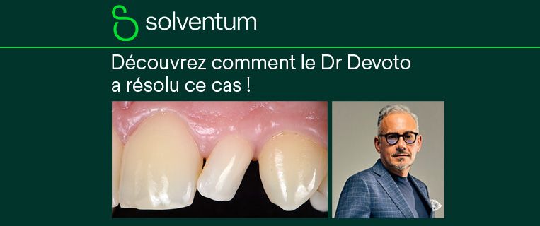 Restauration simplifiée d’une incisive latérale présentant une anomalie de forme et de position