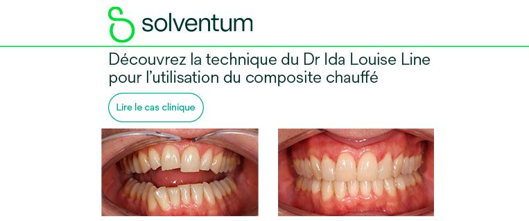 Intérêt du composite chauffé en pratique clinique : cas de restauration directe