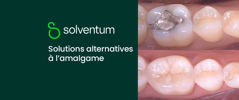 Solutions alternatives à l’amalgame