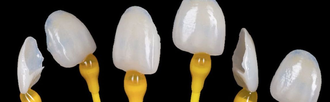 Tout savoir sur les facettes dentaires