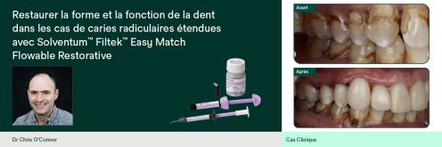 Restaurer la forme et la fonction de la dent dans les cas de caries radiculaires &eacute;tendues avec Solventum&trade; Filtek&trade; Easy Match Flowable Restorative