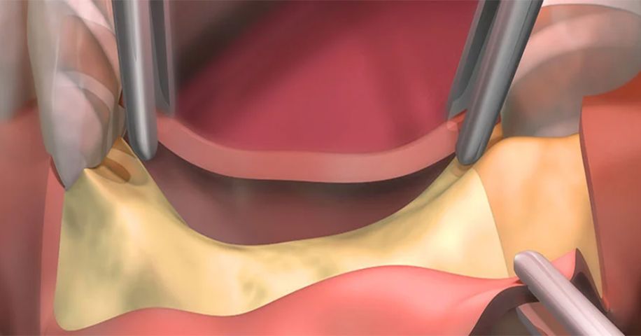 Blog - Régénération osseuse dentaire : naturelle, guidée