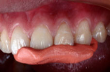 Taking a silicone impression of the fractured tooth