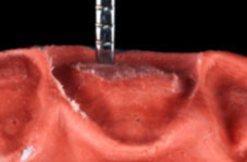 Assessing the depth, matching against equivalent tooth, after occlusal analysis