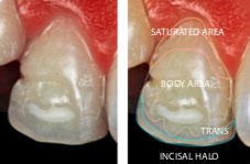 High saturation and contrast photograph: chromatic mapping of the equivalent tooth