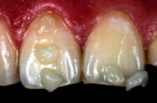 High saturation photograph: assesses the dentine shades