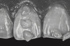 Greyscale photograph: assesses the clarity of the enamel and trans tones (BRILLIANT EverGlow COLTENE)