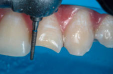 Labial bevelling