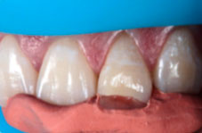 Fitting the silicone impression with resin to the tooth to be restored