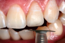 Smoothing with coarse disc