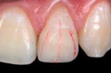 The line angles and tooth axis are marked