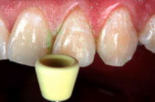 Yellow cup polisher
