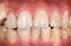 Photograph with retraction