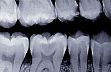 Radiographie rétro-coronaire centrée sur 46