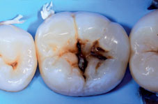Isolation de plusieurs dents
