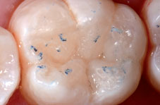 Vérification de l’occlusion