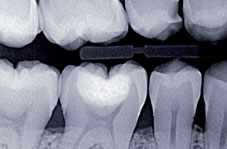 Radiographie postopératoire