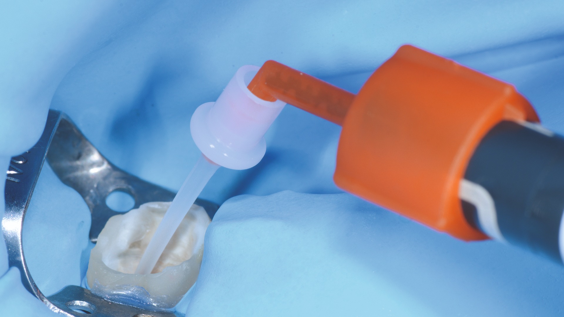 Application du ciment-composite 3M™ RelyX™ Universal.