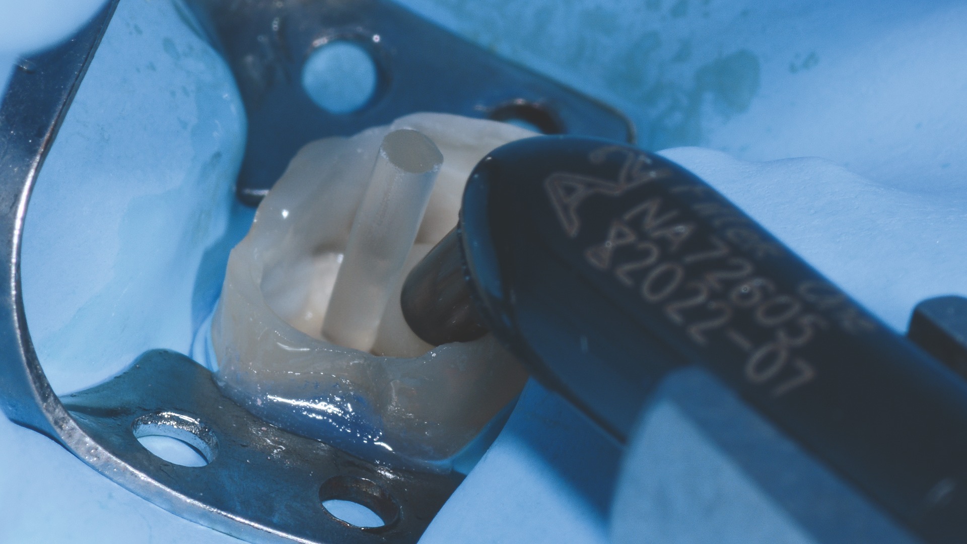 Application du matériau de restauration 3M™ Filtek™ One Bulk Fill Restorative.