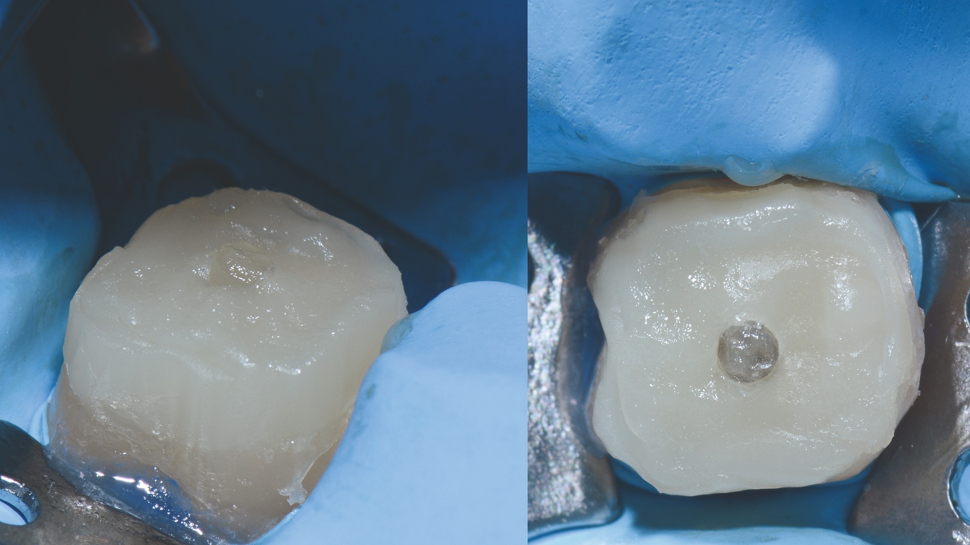 Reconstruction du moignon après photopolymérisation.