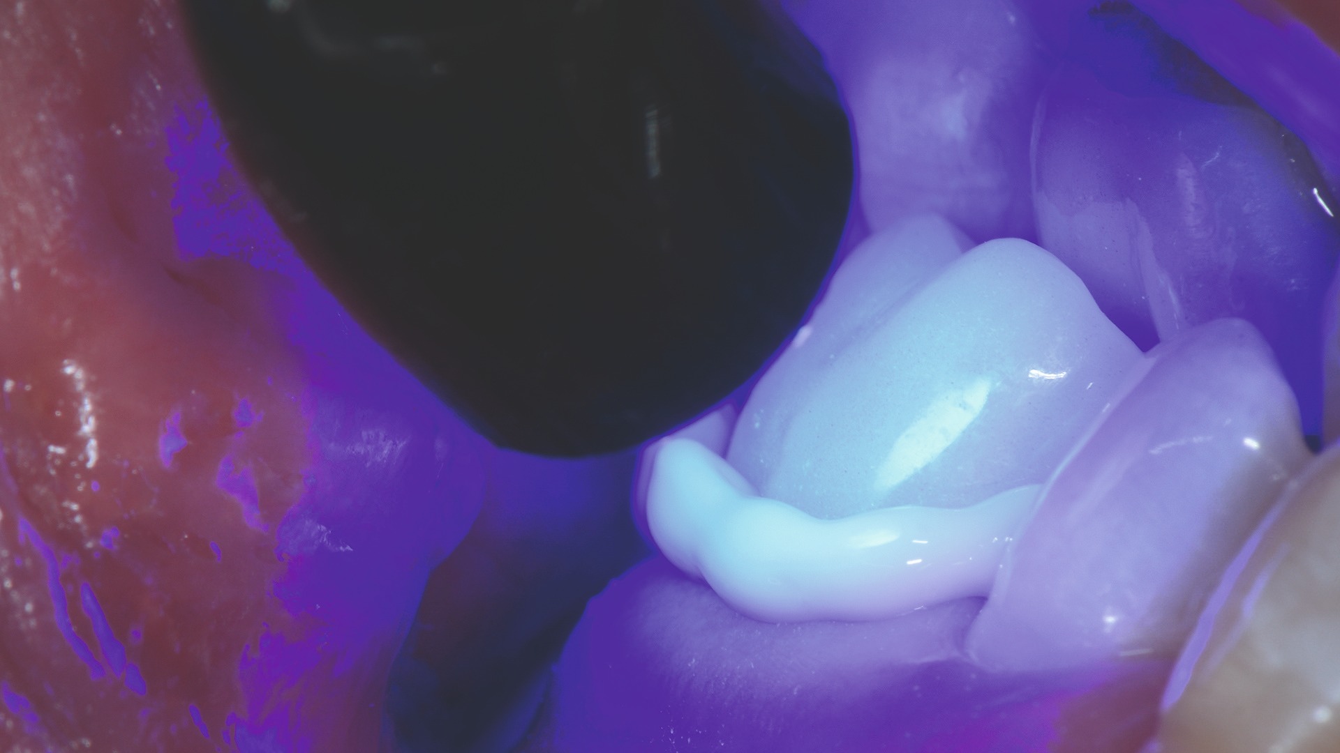 Photopolymérisation initiale courte (tack‑cure) des excès de ciment.
