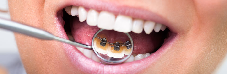 Orthodontie linguale : avantages et inconvénients