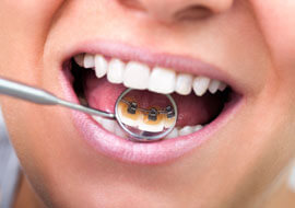 Orthodontie linguale : avantages et inconvénients
