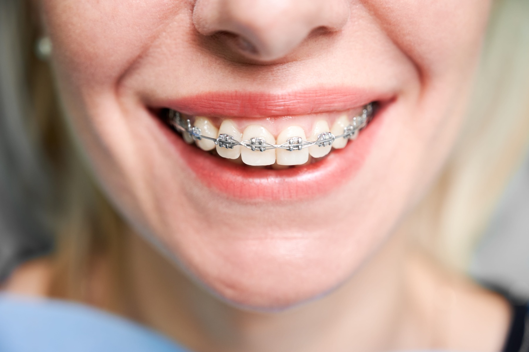 Gros plan détaillé sur des bagues orthodontiques métalliques et des fils.