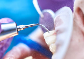 Ultrasons au cabinet dentaire