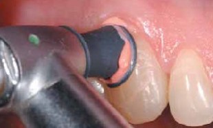 Nettoyer minutieusement les surfaces dentaires