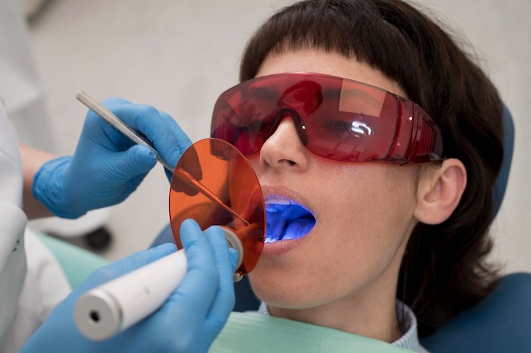 Un dentiste utilise une petite lampe à photopolymériser sur la dent d'un patient.